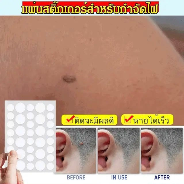 72Pcs Mole removal patch