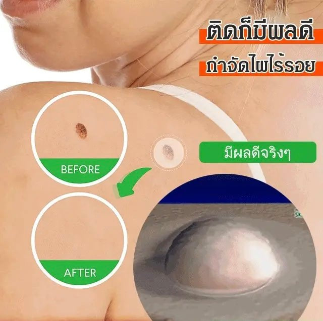 72Pcs Mole removal patch